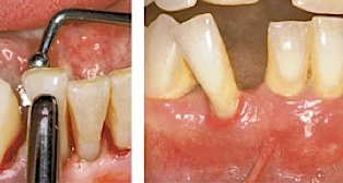 Zahnlockerung durch Zahnfleischentzündung