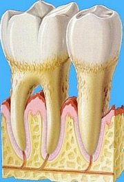 Welche Zahnbürste Bei Parodontose